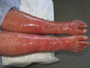 Severe adverse reaction to a drug 