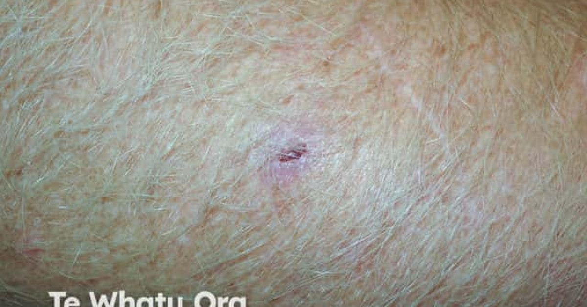 Dermnet® Eroding Basal Cell Carcinoma Arm Image 5394