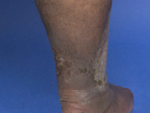 Venous eczema in dark skin