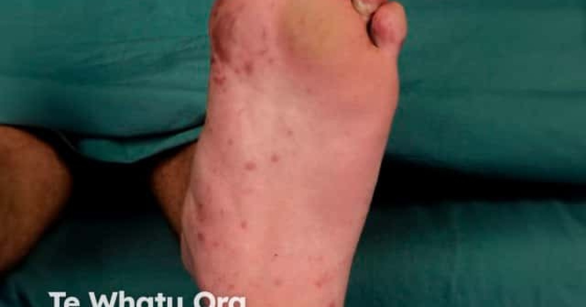 Hand foot and mouth disease image