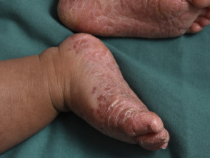 Enteroviral foot blisters