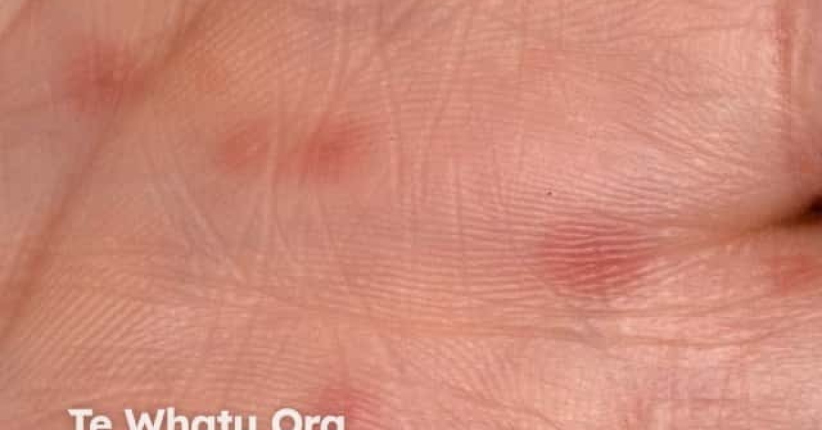 Hand Foot and Mouth Disease image