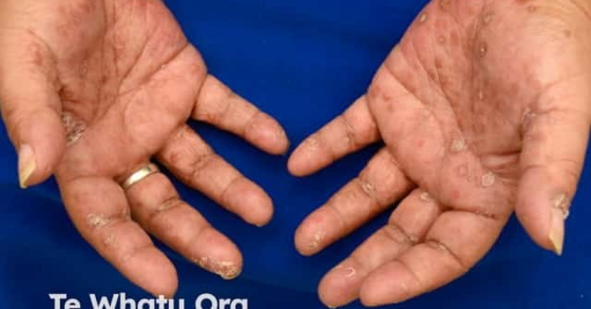 Hand foot and mouth disease image