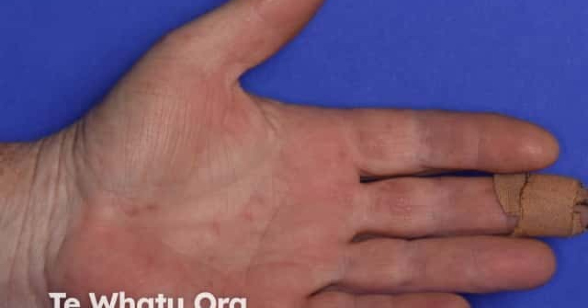 Hand foot and mouth disease image