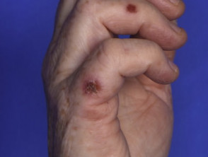 Hand foot and mouth disease