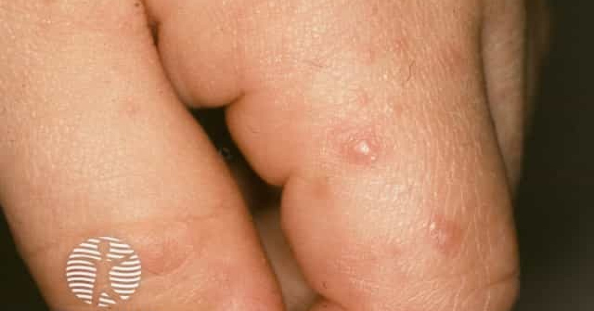 Hand foot and mouth disease image