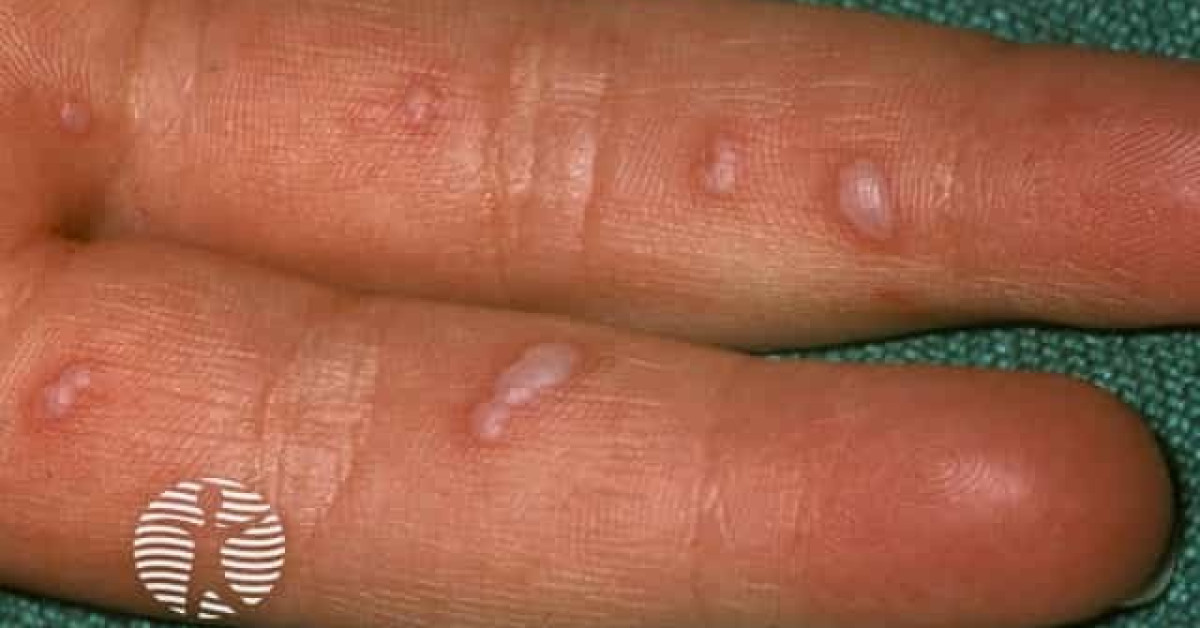 Hand foot and mouth disease image