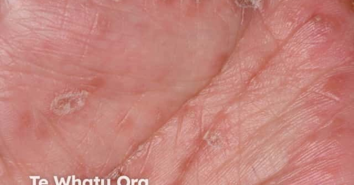 DermNet® - Hand foot and mouth disease image