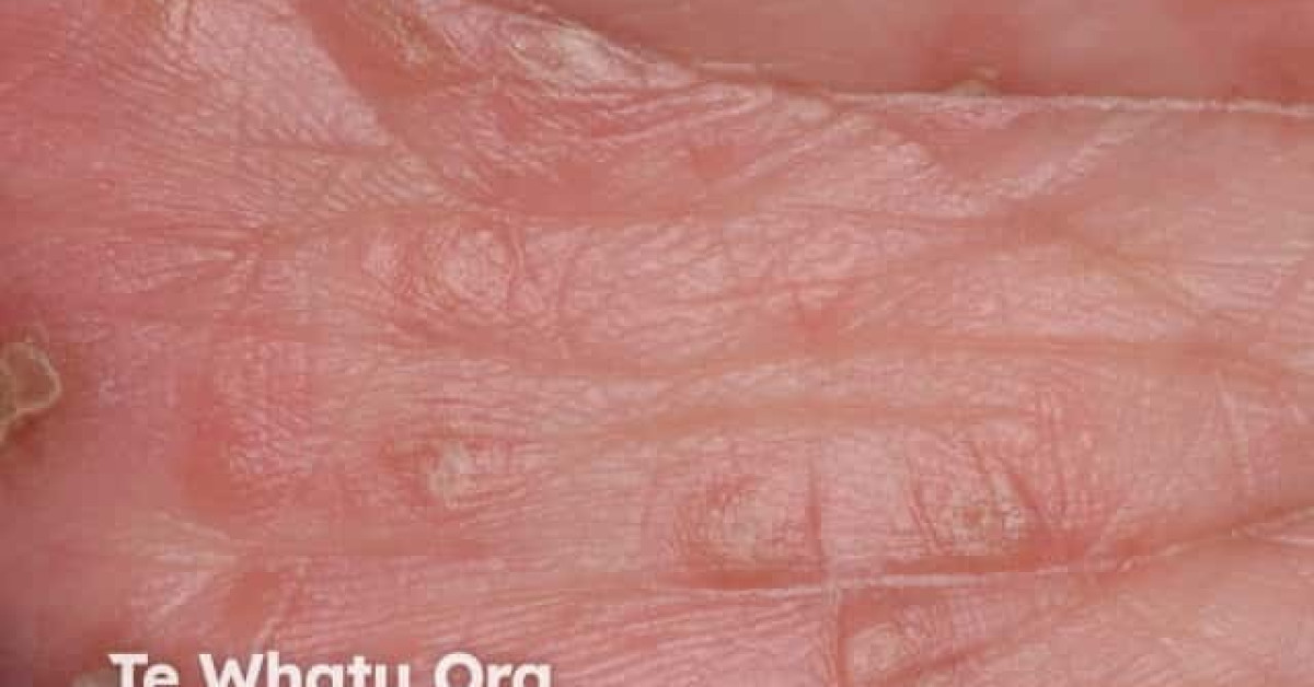Hand foot and mouth disease image