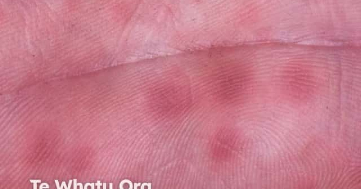 Hand foot and mouth disease image