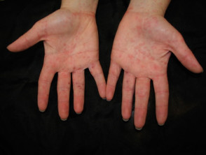 Enteroviral hand blisters