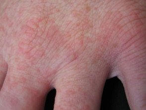 Enteroviral hand blisters