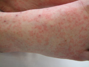 Enteroviral infection rash