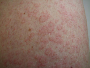 Enteroviral infection rash