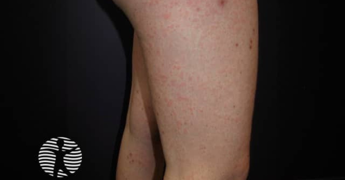 Enteroviral infection rash image