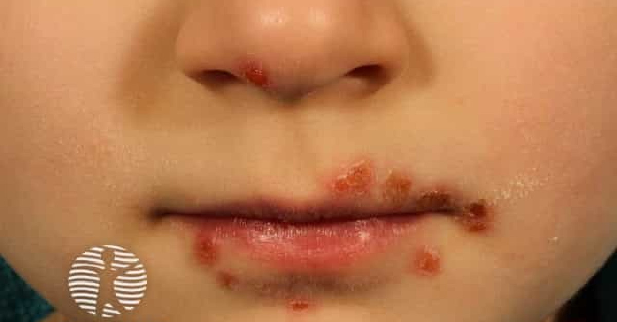 Stomatitis in hand foot and mouth disease image