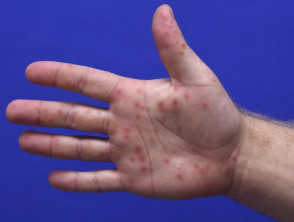 Enteroviral infection: blisters on hand