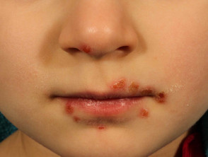 Enterovirus lip blisters