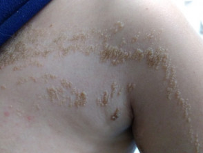 Epidermal naevus syndrome