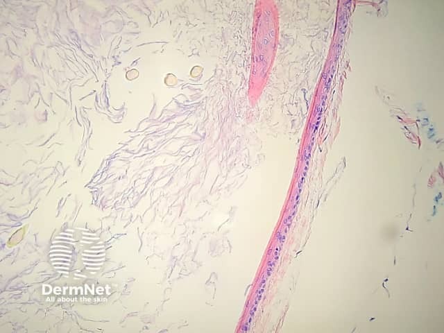 Hair shafts within cyst