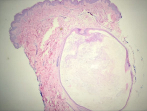 Low power view of histopathology of an eruptive vellus cyst