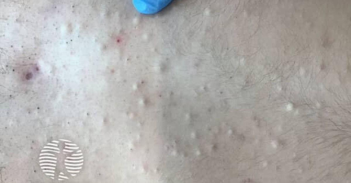 How To Get Rid Of Eruptive Vellus Hair Cysts
