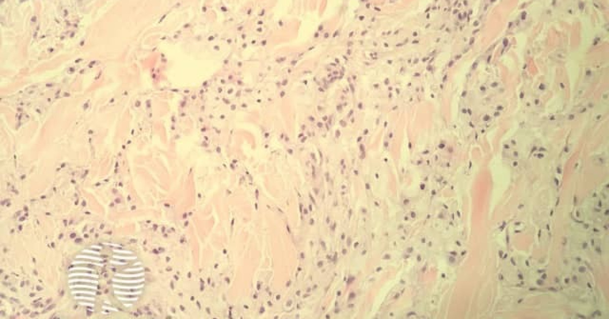 Dermnet® Eruptive Xanthoma Image