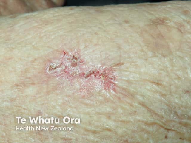 Eroding superficial basal cell carcinoma, arm
