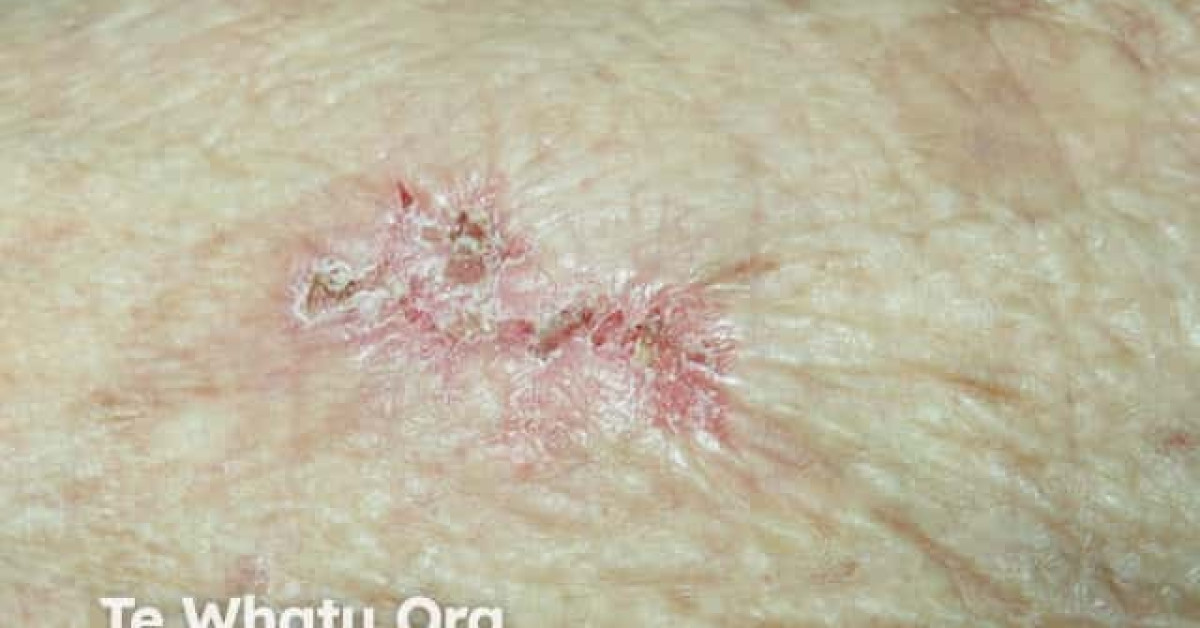 Eroding Superficial Basal Cell Carcinoma Arm Image 4259