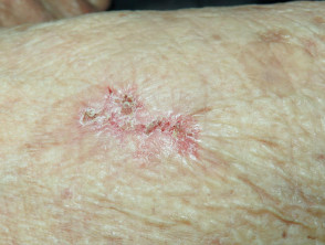 Eroding superficial basal cell carcinoma, arm
