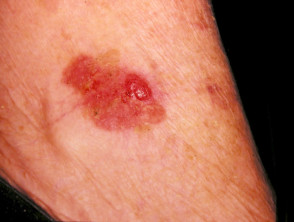 Extramammary Paget disease of the skin of the axilla