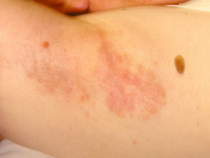 Extramammary Paget disease of the skin of the axilla