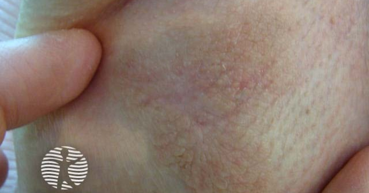 Extramammary Paget disease of the skin of the axilla image