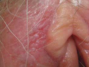 Extramammary Paget disease of the skin of the vulva
