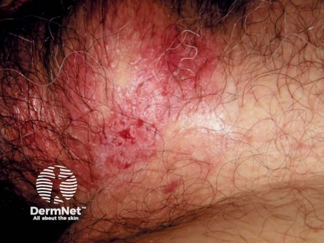 Extramammary Paget disease of the skin of the male genitalia