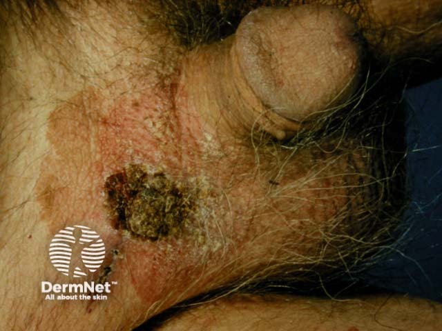 Extramammary Paget disease of the skin of the male genitalia