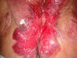 Perianal extramammary Paget disease of the skin