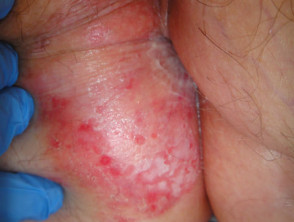 Perianal extramammary Paget disease of the skin