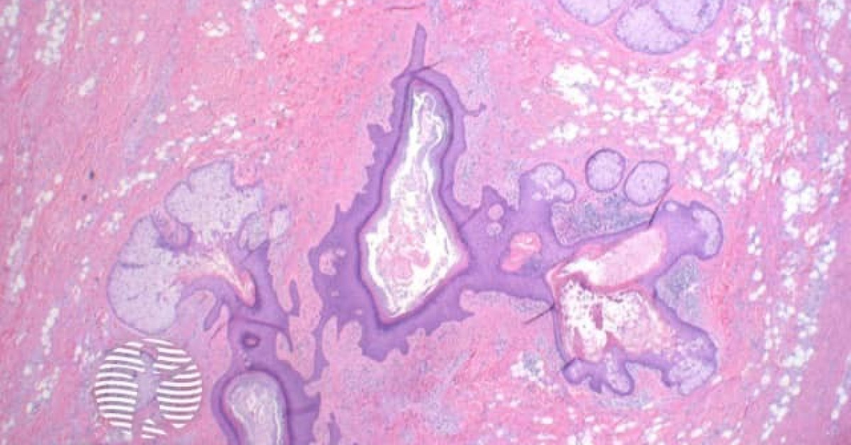 DermNet® - Folliculosebaceous cystic hamartoma histology image