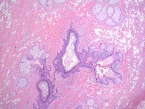 Folliculosebaceous cystic hamartoma histology