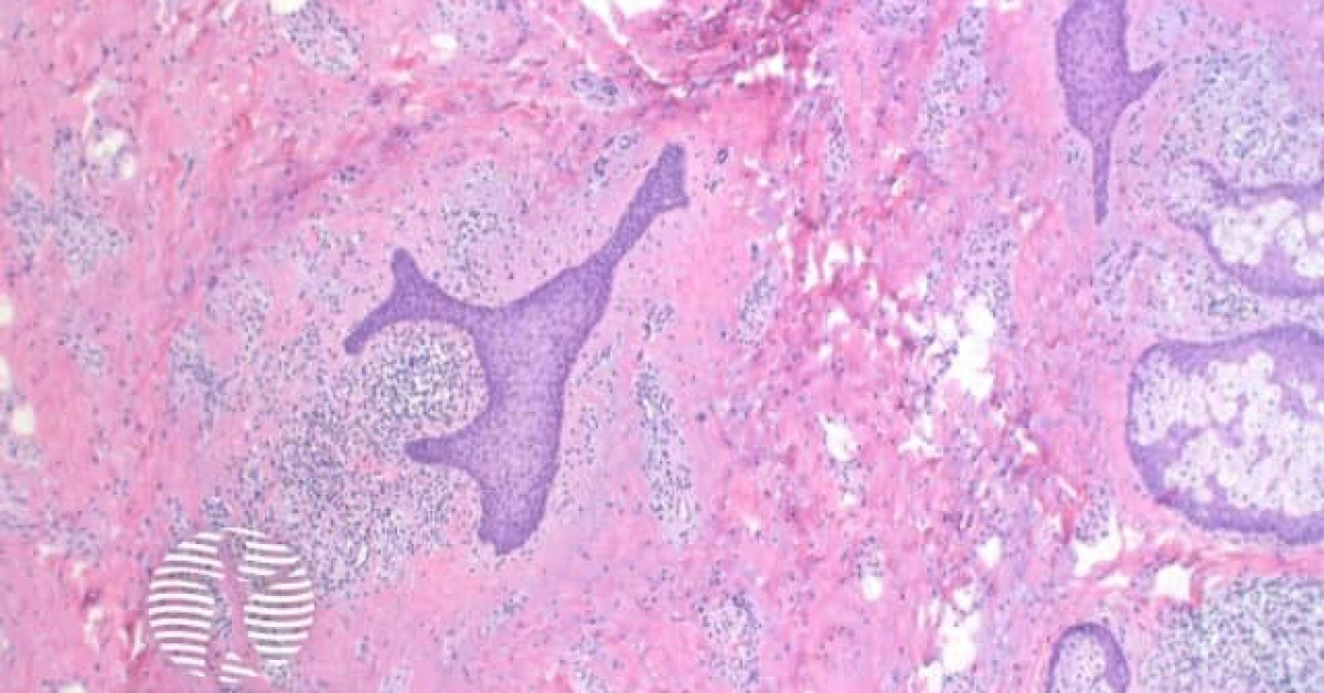 DermNet® - Folliculosebaceous cystic hamartoma histology image