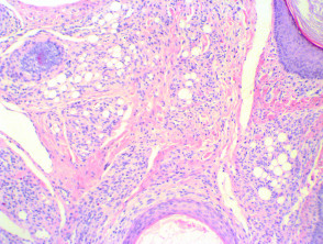 Folliculosebaceous cystic hamartoma histology