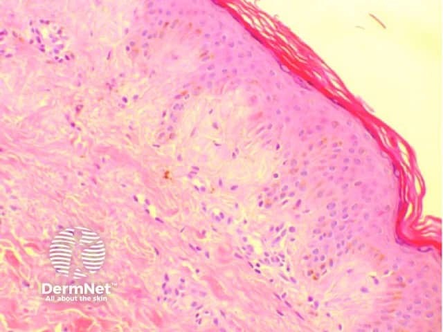 Skin biopsy showing subtle pink globules just underneath the epidermis