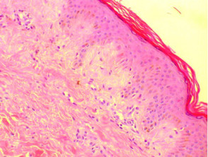 Histology of amyloidosis cutis dyschromica. H+E