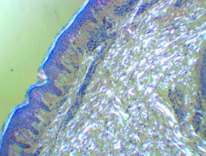 Histology of amyloidosis cutis dyschromica. Polarised congo red