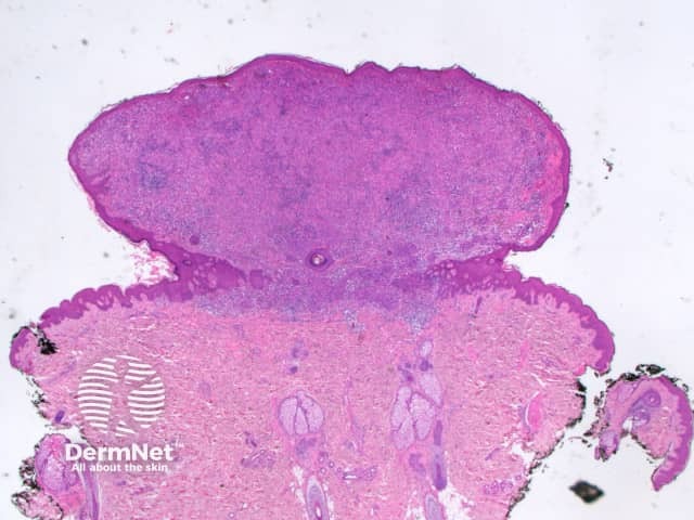 a. Low-power view, haematoxylin and eosin stain