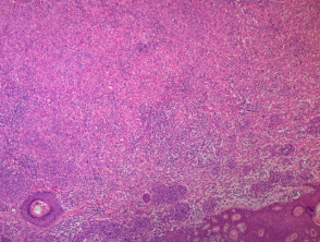 BAP-oma histology x4 H&E. Large epithelioid melanocytes and surrounding smaller regular melanocytes.