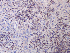 BAP-oma histology x20, IHC. Loss of BAP1 expression (brown staining) of larger epithelioid melanocytes, while regular melanocytes retain BAP1 expression.