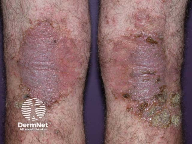 Infected atopic dermatitis