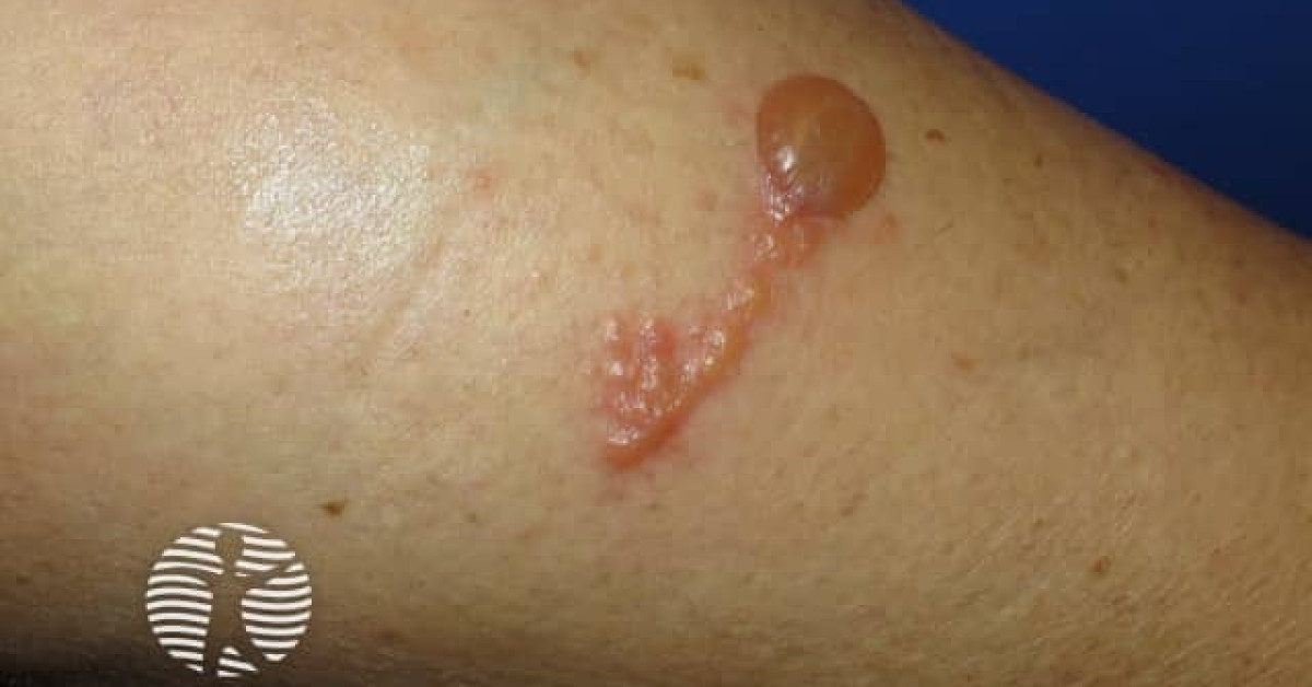 figure 15 blistering image